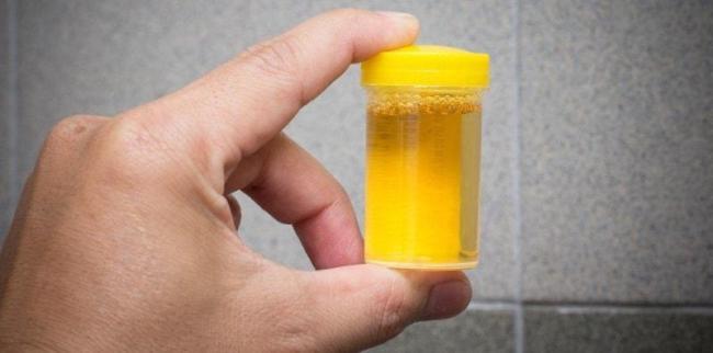 Benarkah Jika Warna Air Kencing Keruh Macam Dalam Gambar, Tanda Diabetes?