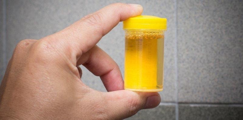 Benarkah Jika Warna Air Kencing Keruh Macam Dalam Gambar, Tanda Diabetes?