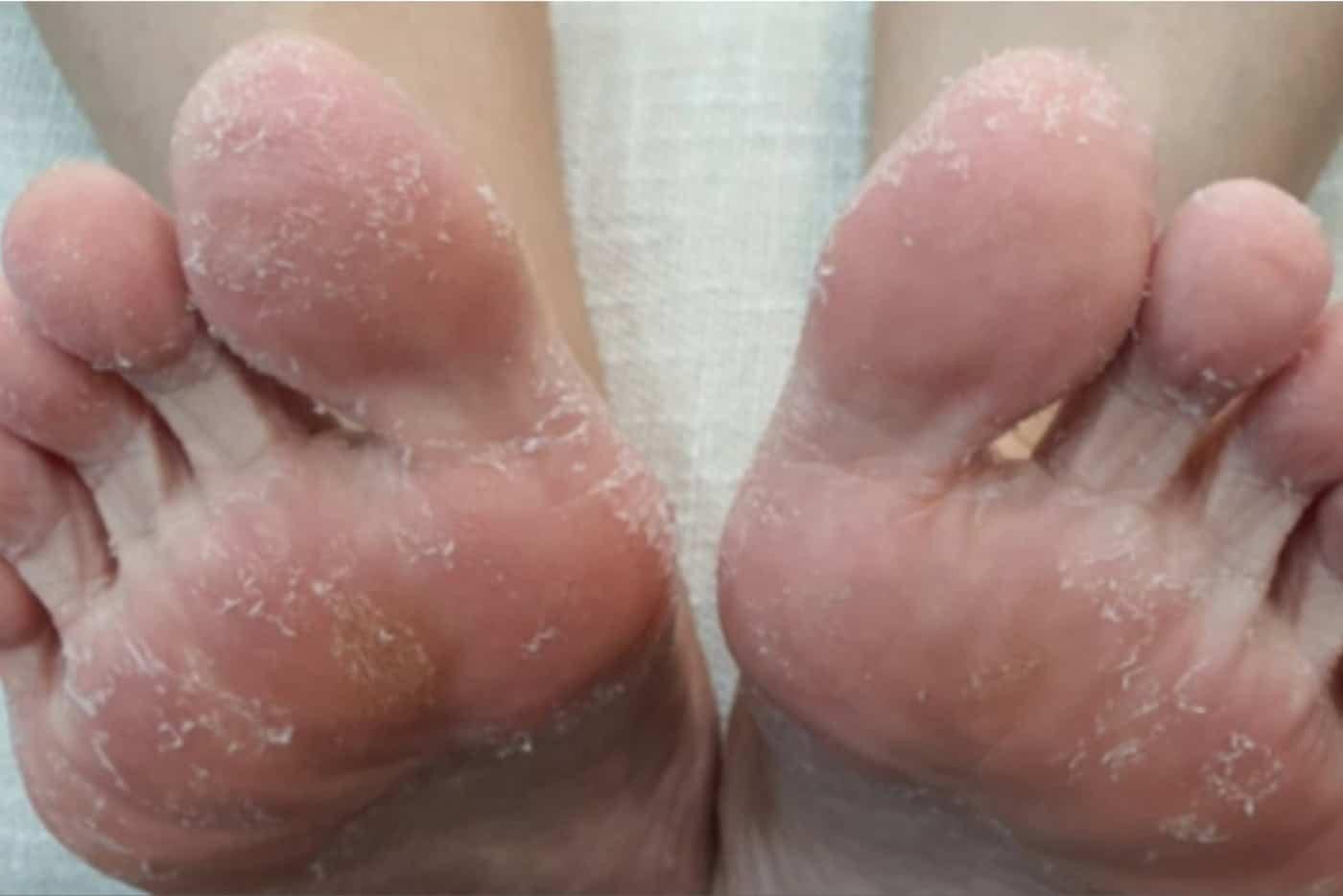 Bukan Sebab Kulit Kering Saja, Ada 5 Punca Utama Kulit Kaki Mengelupas!