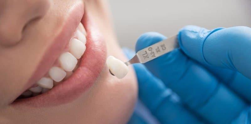 Pasang 'Crown' Untuk 'Cover' Gigi Rosak, Ini 5 Bahaya Yang Bakal Datang!