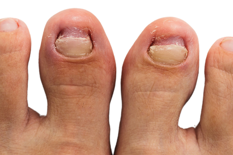 Kuku Kaki Cengkam? Ini Dia 10 Punca Serta 5 Cara Untuk Rawat Cagu!