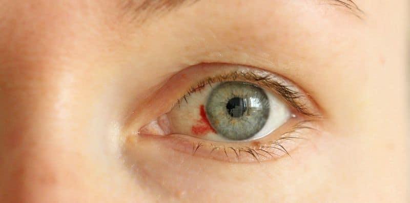 Punca Pembuluh Darah Pecah, Tekanan Darah Tinggi Adalah Salah Satunya! Boleh Sebabkan Kematian!