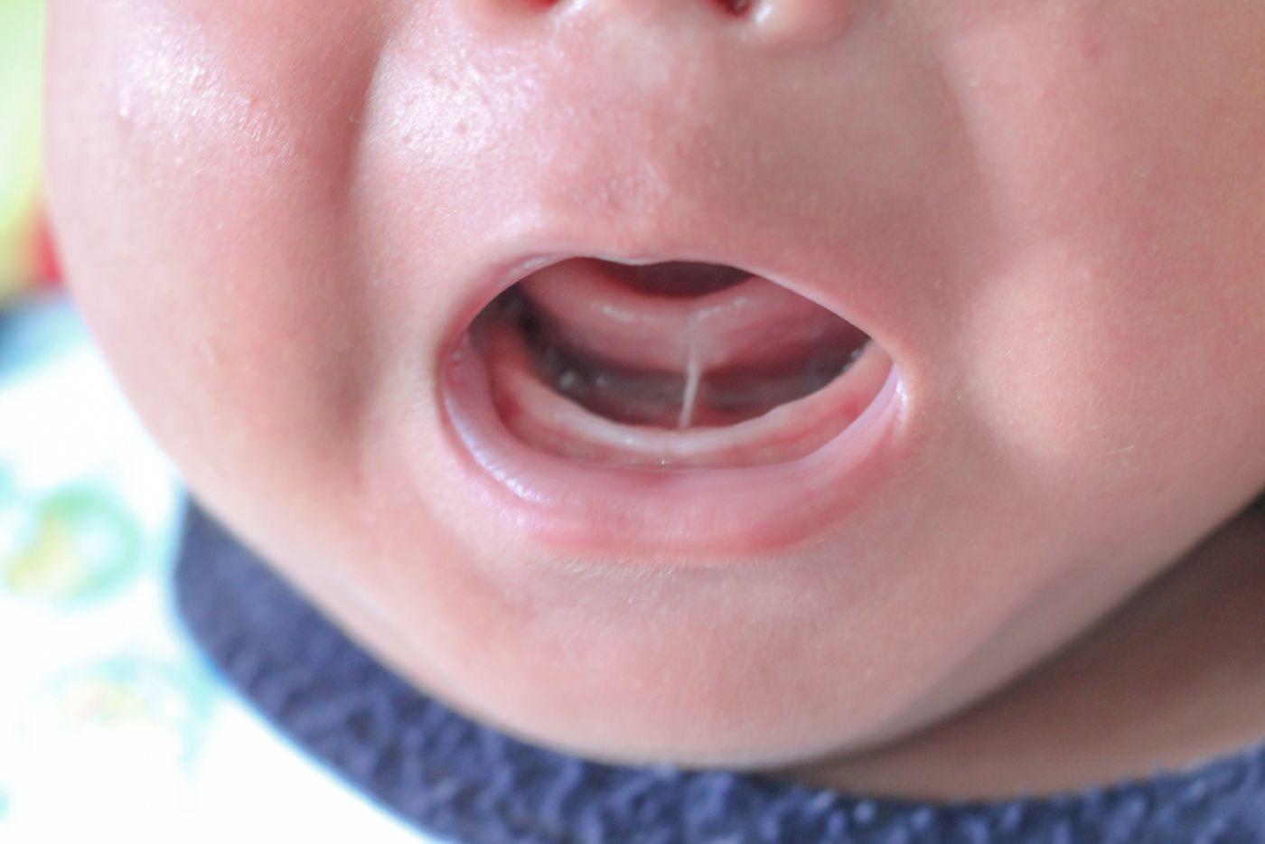 Bayi Ada Masalah Lidah Pendek? Mama, Ini 10 Cara Yang Betul Untuk Kenal Pasti!