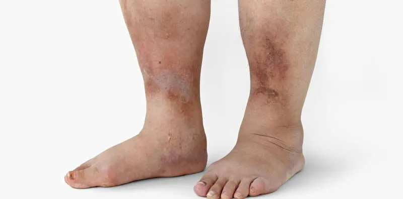 Kaki Bengkak Kerana Diabetes? Cuba 5 Petua Ini Untuk Surutkan Bengkak Anda!