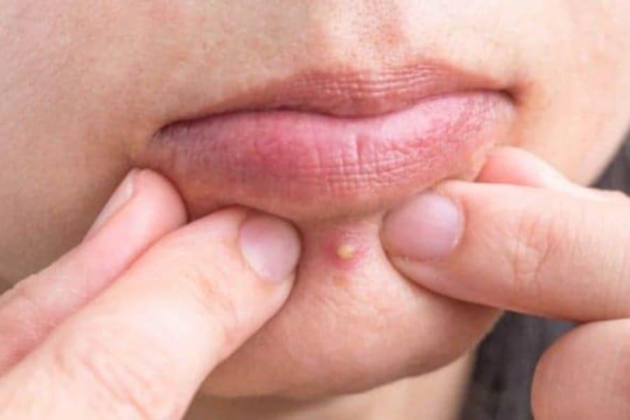 Kerap Sangat Jerawat Tumbuh Di Dagu? Usah Risau, Jom Rawat Dengan 6 Cara Ini!