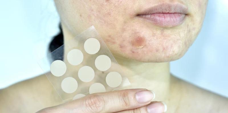 Tutup Jerawat Dengan Plaster Acne Patch, Menyembuhkan Atau Memburukkan?