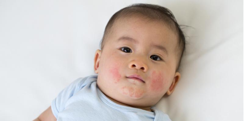 Pipi Bayi Berkudis Selepas Menyusu Badan? Ini Cara Untuk Atasi Ruam Ekzema!