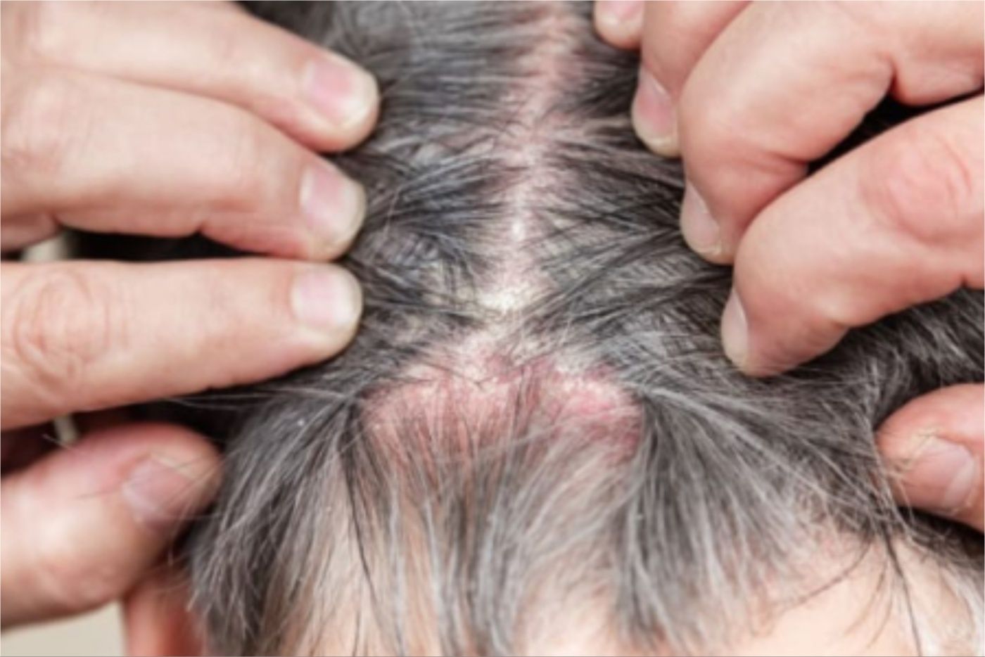 Kulit Kepala Berkuping Bukan Kerana Kelemumur Sahaja, Ada 5 Sebab Lain!