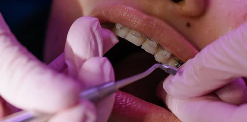 Ada Ke Jenis Gigi Yang Tak Boleh Pakai Braces? Sebab Itulah Perlu Lakukan Konsultasi Dulu!