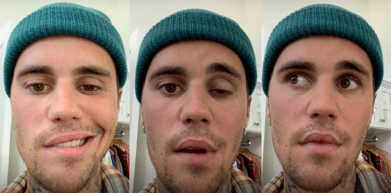 Justin Bieber Lumpuh Sebelah Muka? Ini Tanda Anda Boleh Terkena Sindrom Ramsay Hunt!