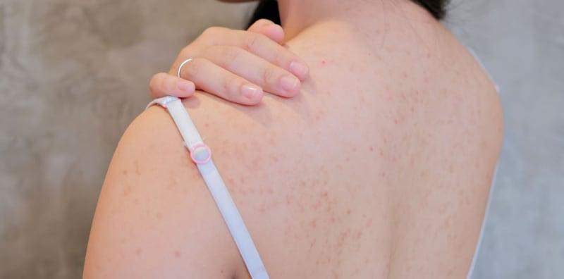 Hilangkan Jerawat Badan Dengan 6 Bahan Natural Ini, Selamat Dan Berkesan!