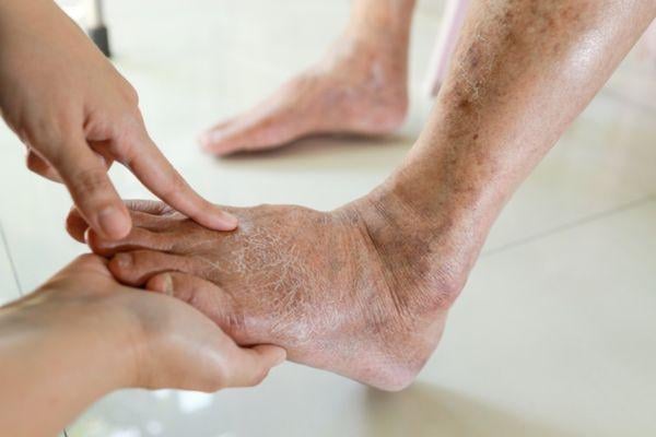 kaki gatal diabetes