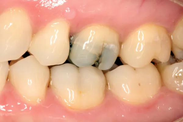 kenapa gigi geraham sakit padahal tidak berlubang