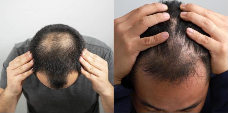 5 Treatment Rambut Gugur Yang Anda Mesti Cuba, No. 4 Boleh Buat Di Rumah!