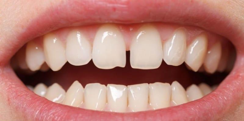 Ada Masalah Gigi Jarang? Ini 7 Puncanya, Tabiat Hisap Jari Masa Kecil Pun Termasuk?