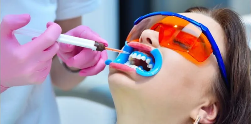 Nak Putihkan Gigi? Ini Anggaran Harga Whitening Gigi Klinik Swasta Perlu Anda Tahu