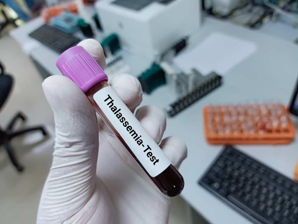 thalassaemia menyebabkan pembentukan yang tidak normal pada