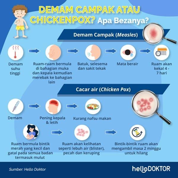cacar monyet di malaysia