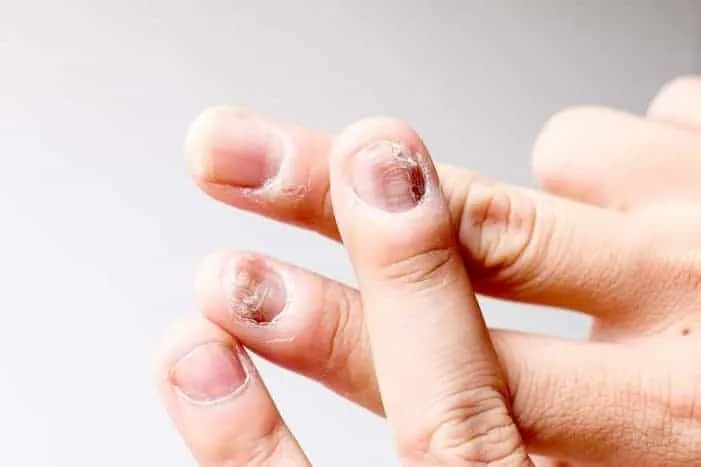 psoriasis kuku