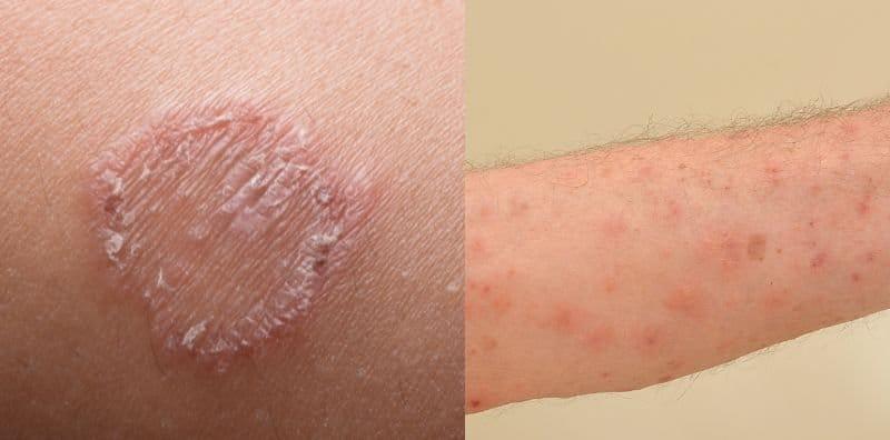 Antara Kurap @ Kudis, Kenali & Ketahui Beza Keduanya, Baru Senang Nak Rawat!