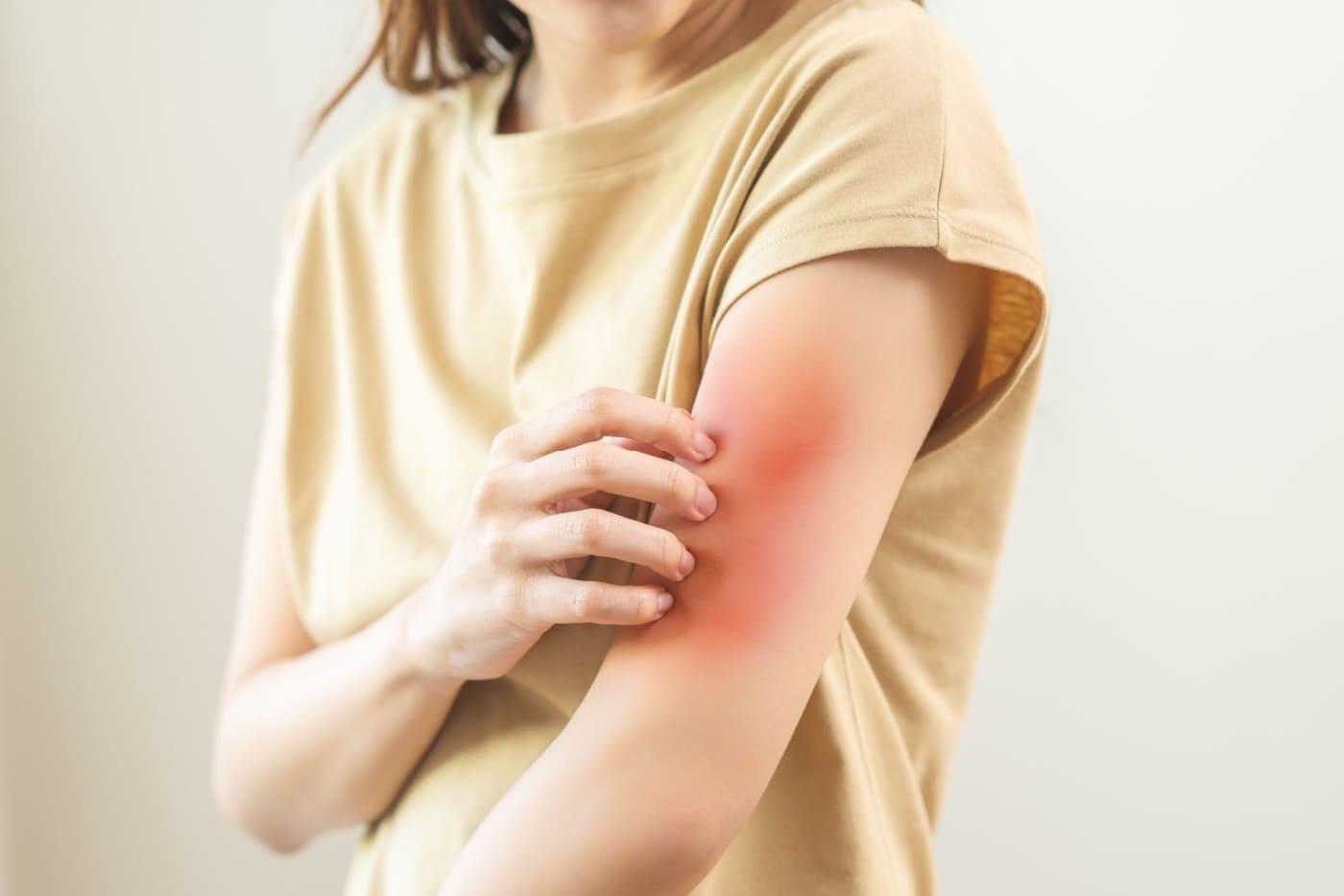 Dah Cuba Macam-Macam Tapi Masih Gatal? 3 Ubat Ini Confirm Lega Cepat!