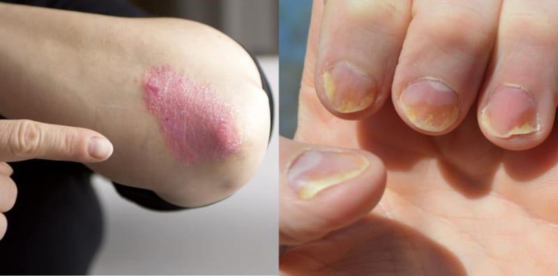 psoriasis-kuku