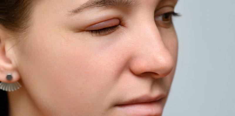 Bangun Tidur Tengok Mata Sembap? Ini 10 Punca Mata Bengkak Secara Tiba-Tiba!