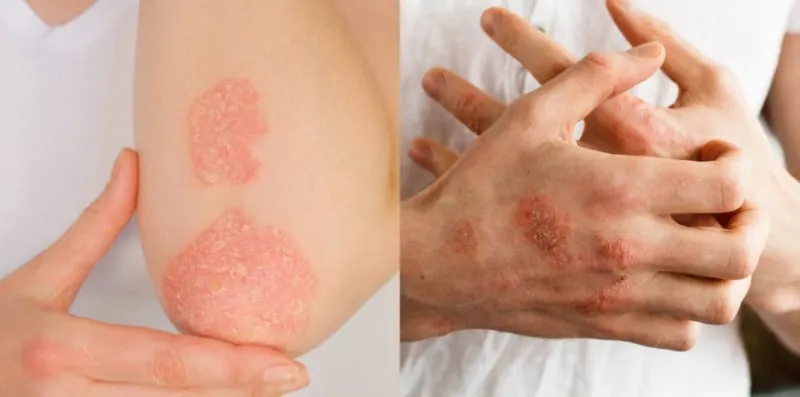 pantang-larang-penyakit-psoriasis
