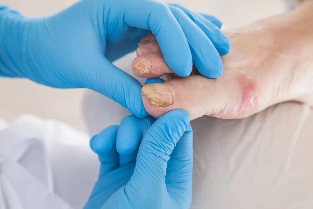 psoriasis kuku