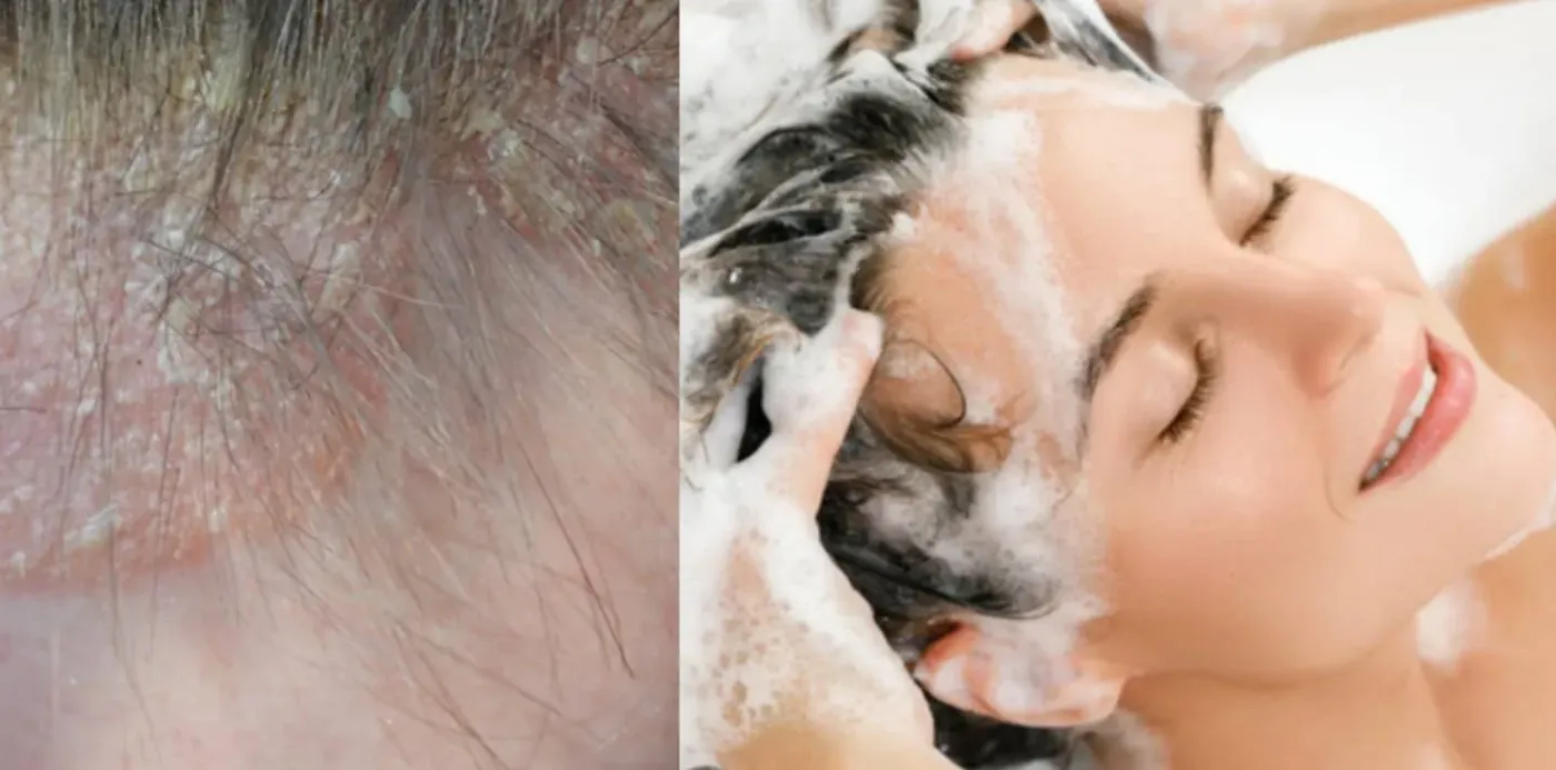 8 Bahan Penting Harus Ada Dalam Syampu Untuk Psoriasis, Baru Lega Gatal-gatal!