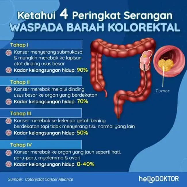 tahap kanser kolon