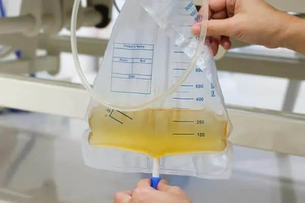 Suprapublic catheter
