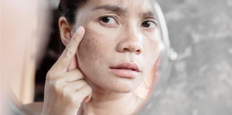 Wanita Berusia 30 Tahun Ke Atas Berisiko Tinggi Alami Jeragat Muka! Ini 5 Puncanya