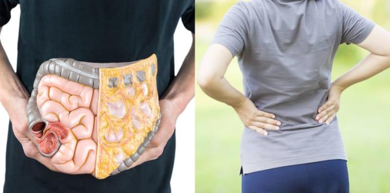 tahap-kanser-kolon