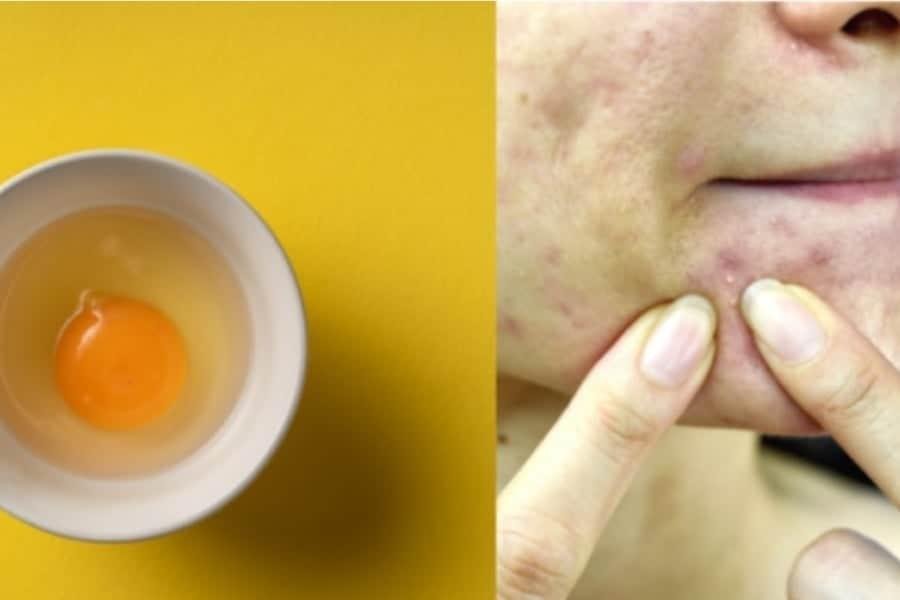 Muka Banyak Bintik Putih? Ini 5 Cara Tradisional Hilangkan Whitehead Di Wajah!