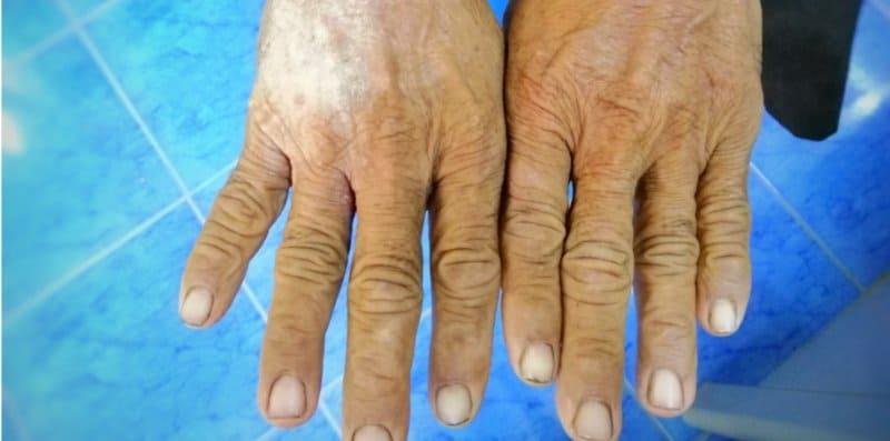 Kulit Jari Keras Dan Menebal? Kalau Anda Penghidap Diabetes, Ini Mungkin Puncanya