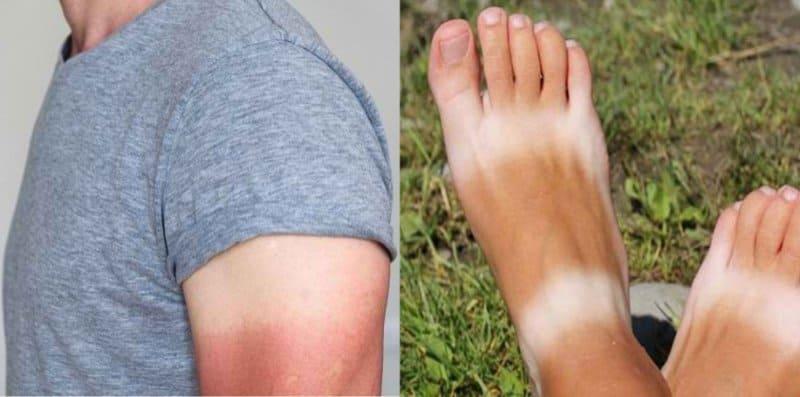 Jom Putihkan Tangan Dan Kaki Yang Gelap Atau Berbelang Dengan 5 Cara Ini!