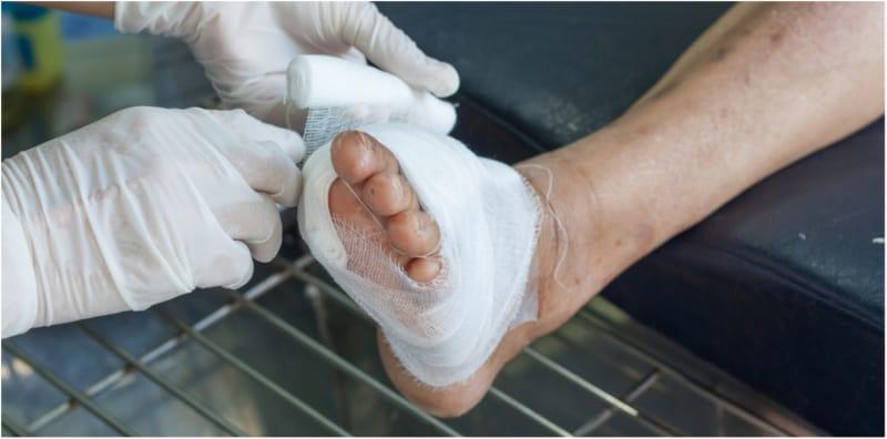 Ada 2 Sebab Kenapa Luka Diabetes Lambat Sembuh, Boleh Bernanah Kalau Terus Dibiarkan!