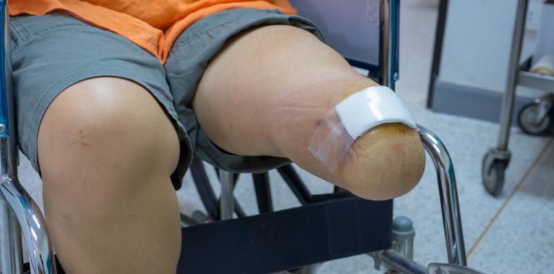 Penghidap Diabetes Boleh Dipotong Kaki Kalau Tak Kawal Paras Gula! Ini Sebab Amputasi