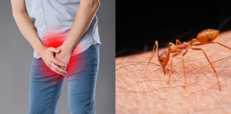 Kemaluan Lelaki Gatal Seperti Digigit Semut? Ada 5 Punca Perlu Diberi Perhatian!