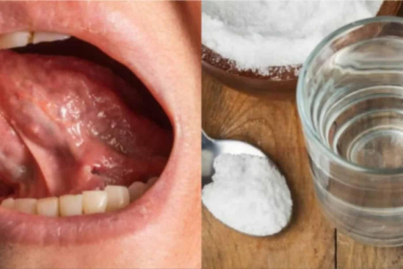 Selain Gunakan Ubat Farmasi, Ada 7 Lagi Cara Efektif Hilangkan Ulser Lidah Tradisional!
