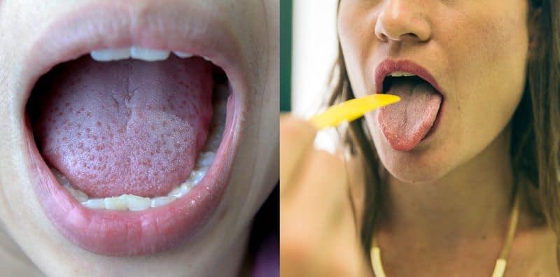 Lidah Berwarna Putih? Mungkin Sebab Anda Selalu 'Skip' Gosok Gigi!