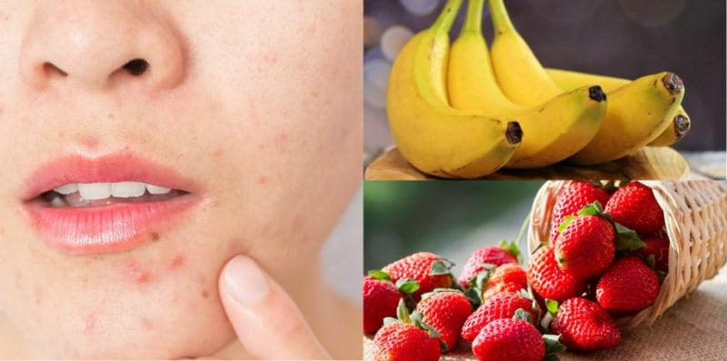 Menakjubkan! 6 Jenis Buah Ini Boleh Buat Jerawat Anda Kecut, Pudar Dan Hilang!