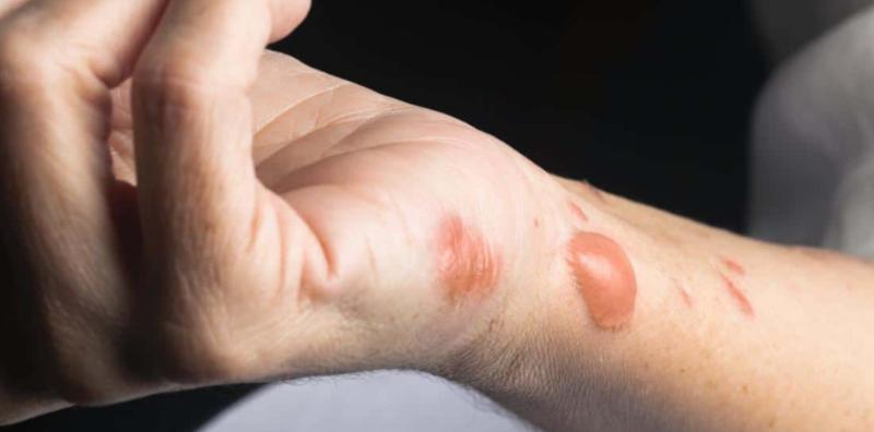 Bagaimana Luka Kebakaran Boleh Jadi Punca Kematian? 3 Perkara Ini Puncanya!