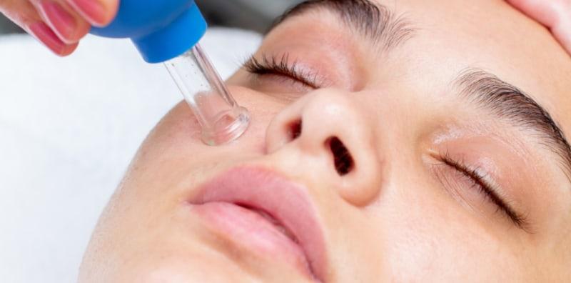 Bahaya Ke Buat Bekam Muka? Lepas Tahu 9 Manfaat Ini, Pasti Anda Ingin Cuba!