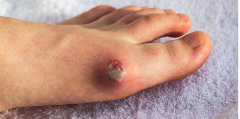 Mengapa Orang Diabetes Senang Dapat Jangkitan, Luka Pun Lambat Sembuh? Ini Sebabnya!