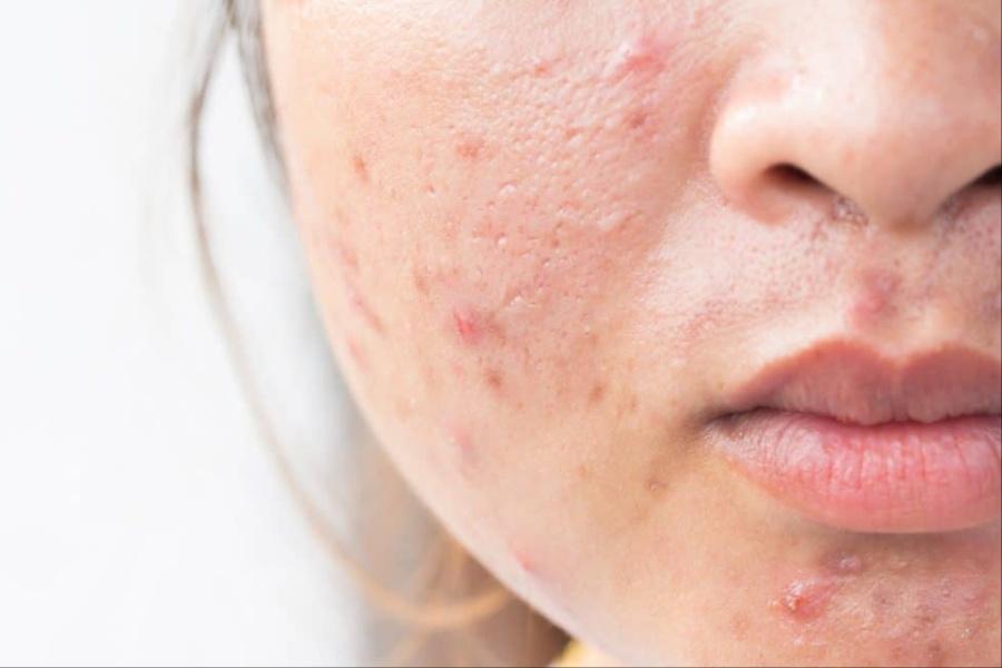 5 Cara Kecutkan Jerawat Dalam Masa 1 Hari Sahaja! Tak Percaya? Jom Kita Cuba!