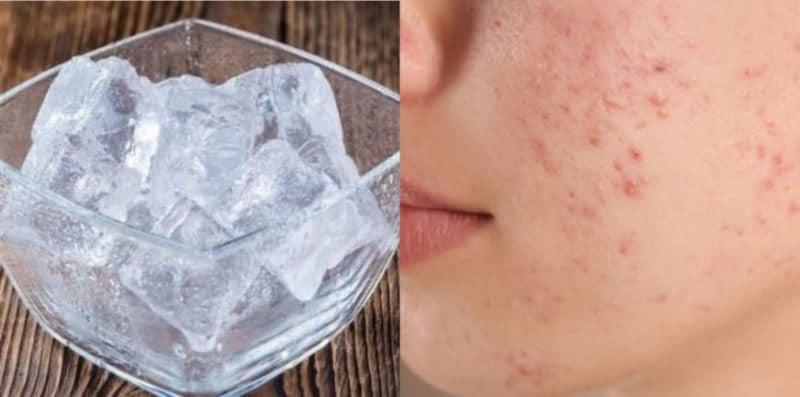 Ais Batu Hilangkan Parut Jerawat? Ini Rahsia Kulit Bersih Orang Iceland!