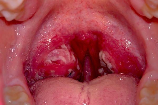 tonsil bengkak