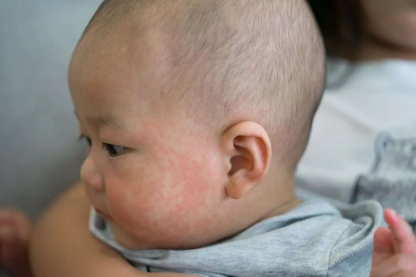 Ruam Merah Pada Badan Anak? AWAS, Ia Mungkin Tanda Penyakit Kawasaki Ini!